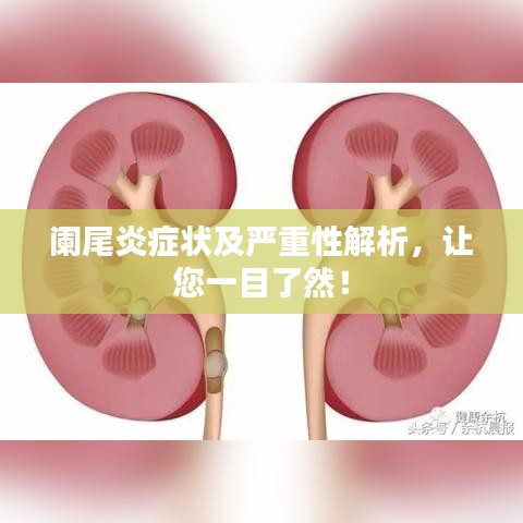阑尾炎症状及严重性解析，让您一目了然！